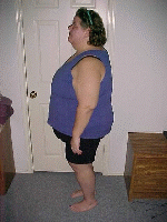 2 Month Post-Op